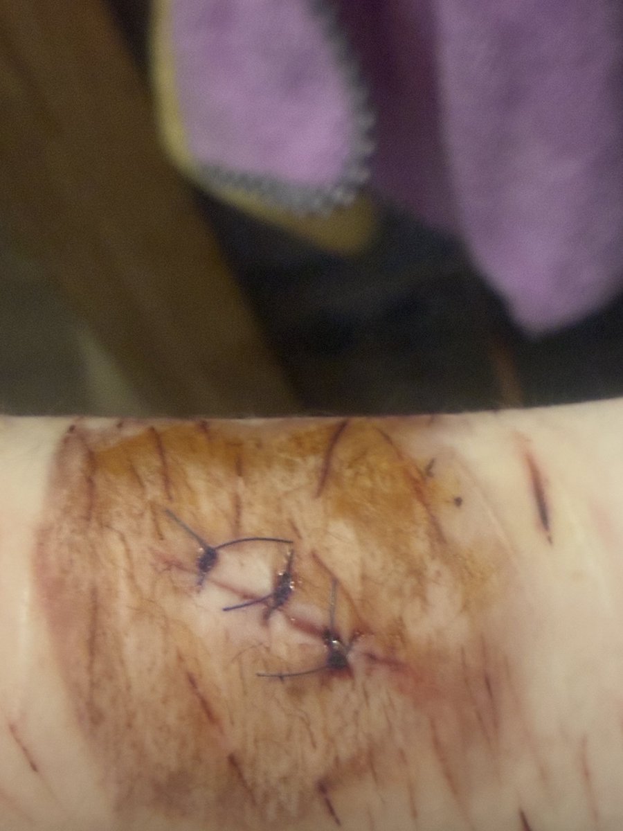 grokrocka's tweet image. update on the beans cut + disgusting bandage (the brown stuff is a disinfectant)

#shtwt #slittwt #sh