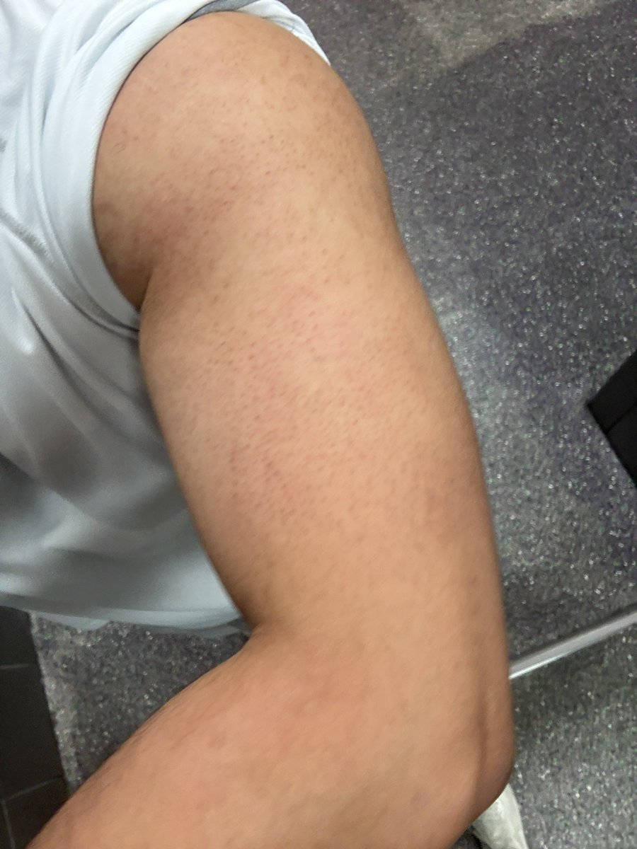 strberry_acai's tweet image. Finally starting to see striations

#muscle
#body
#flex