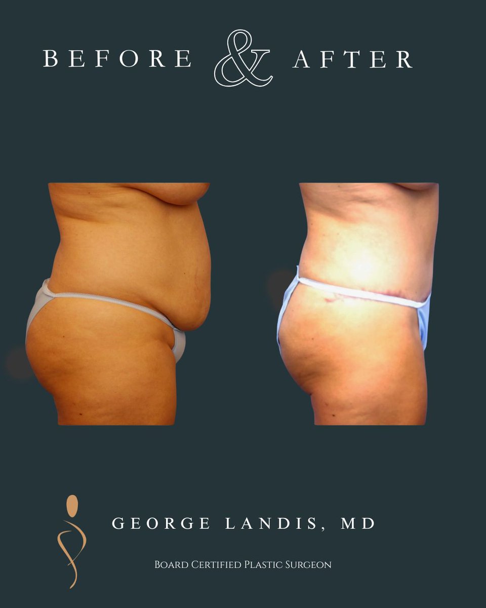 LandisPlastic's tweet photo. After her tummy tuck, this 48‑year‑old patient experienced changes that went far beyond appearance:

✔️ Feeling **less self‑conscious** and **more confident** in a wider range of outfits
✔️ Enjoying **yoga pants and bathing suits** with comfort and ease
✔️ Even noticing **some relief in her lower back pain**

When you feel better in your body, it shows—in how you move, dress, and carry yourself every day. 💫

Considering a tummy tuck? Results are as individual as you are.