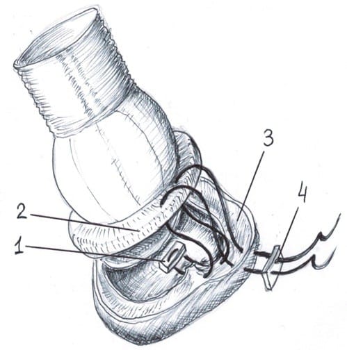 Heart, Vessels and Transplantation tweet media