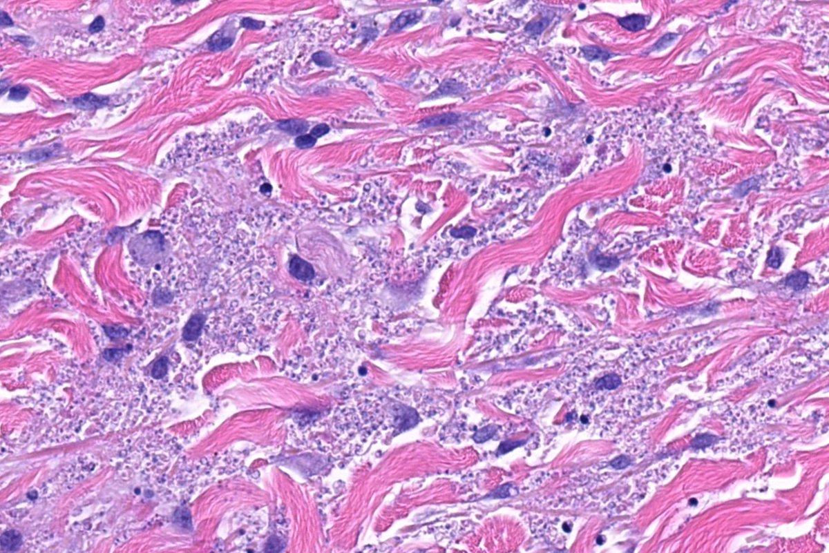 JMGardnerMD's tweet image. 35 M. Multiple papules on trunk &amp;amp; extremities. Your diagnosis?
WSI digital slide 🔬 kikoxp.com/posts/1994
Answer ✅ youtube.com/watch?v=o5blch… 
See also: kikoxp.com/posts/4848 
#pathology #pathologists #pathTwitter #dermpath #dermatology #dermatologia #dermtwitter