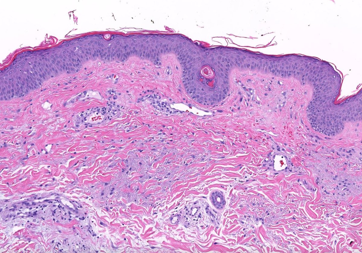 JMGardnerMD's tweet image. 35 M. Multiple papules on trunk &amp;amp; extremities. Your diagnosis?
WSI digital slide 🔬 kikoxp.com/posts/1994
Answer ✅ youtube.com/watch?v=o5blch… 
See also: kikoxp.com/posts/4848 
#pathology #pathologists #pathTwitter #dermpath #dermatology #dermatologia #dermtwitter