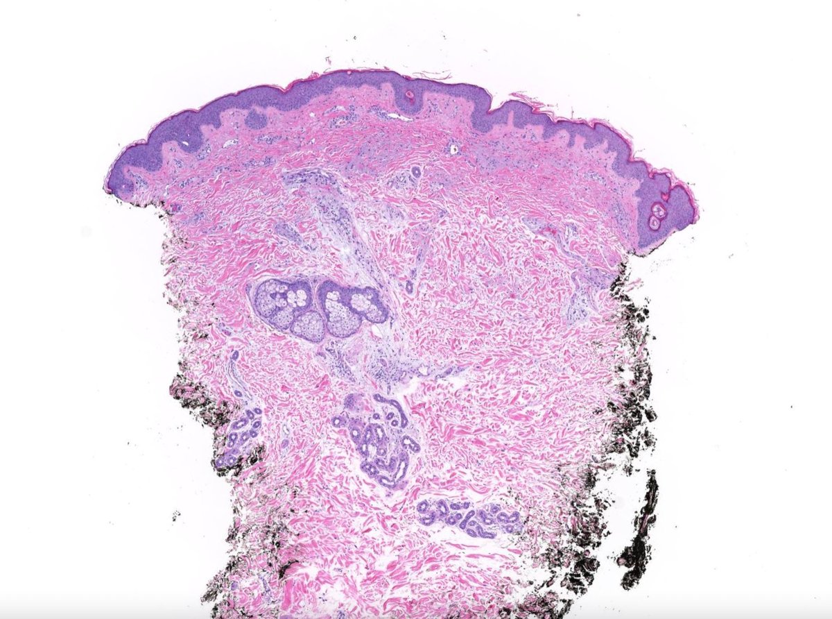 JMGardnerMD's tweet image. 35 M. Multiple papules on trunk &amp;amp; extremities. Your diagnosis?
WSI digital slide 🔬 kikoxp.com/posts/1994
Answer ✅ youtube.com/watch?v=o5blch… 
See also: kikoxp.com/posts/4848 
#pathology #pathologists #pathTwitter #dermpath #dermatology #dermatologia #dermtwitter