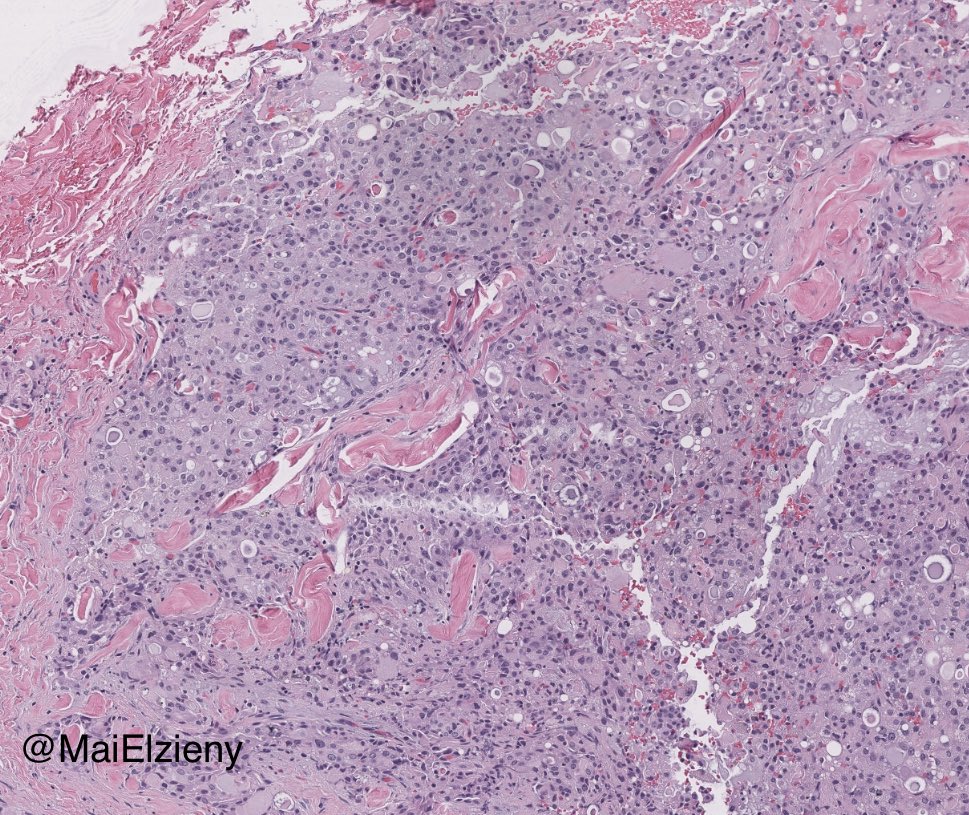 MaiElzieny's tweet image. Same parotid!
2 different locations!
2 different tumors!
#Pathology 
#PathX 
#PathTwitter