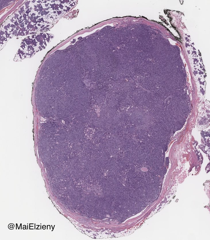 MaiElzieny's tweet image. Same parotid!
2 different locations!
2 different tumors!
#Pathology 
#PathX 
#PathTwitter