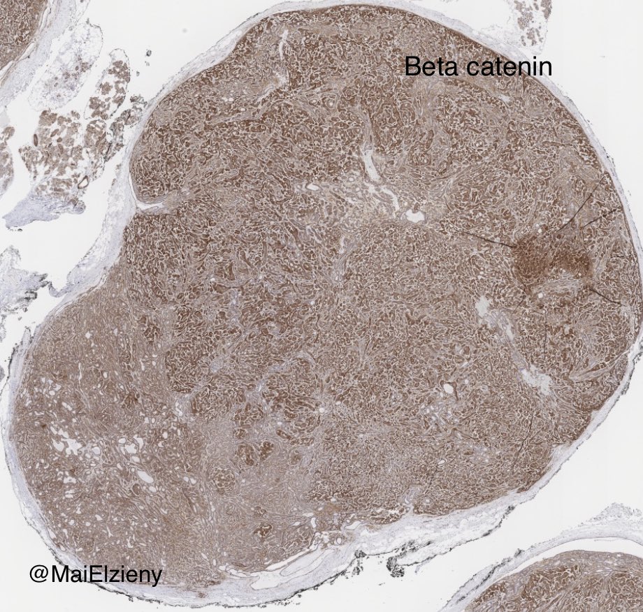 MaiElzieny's tweet image. Same parotid!
2 different locations!
2 different tumors!
#Pathology 
#PathX 
#PathTwitter