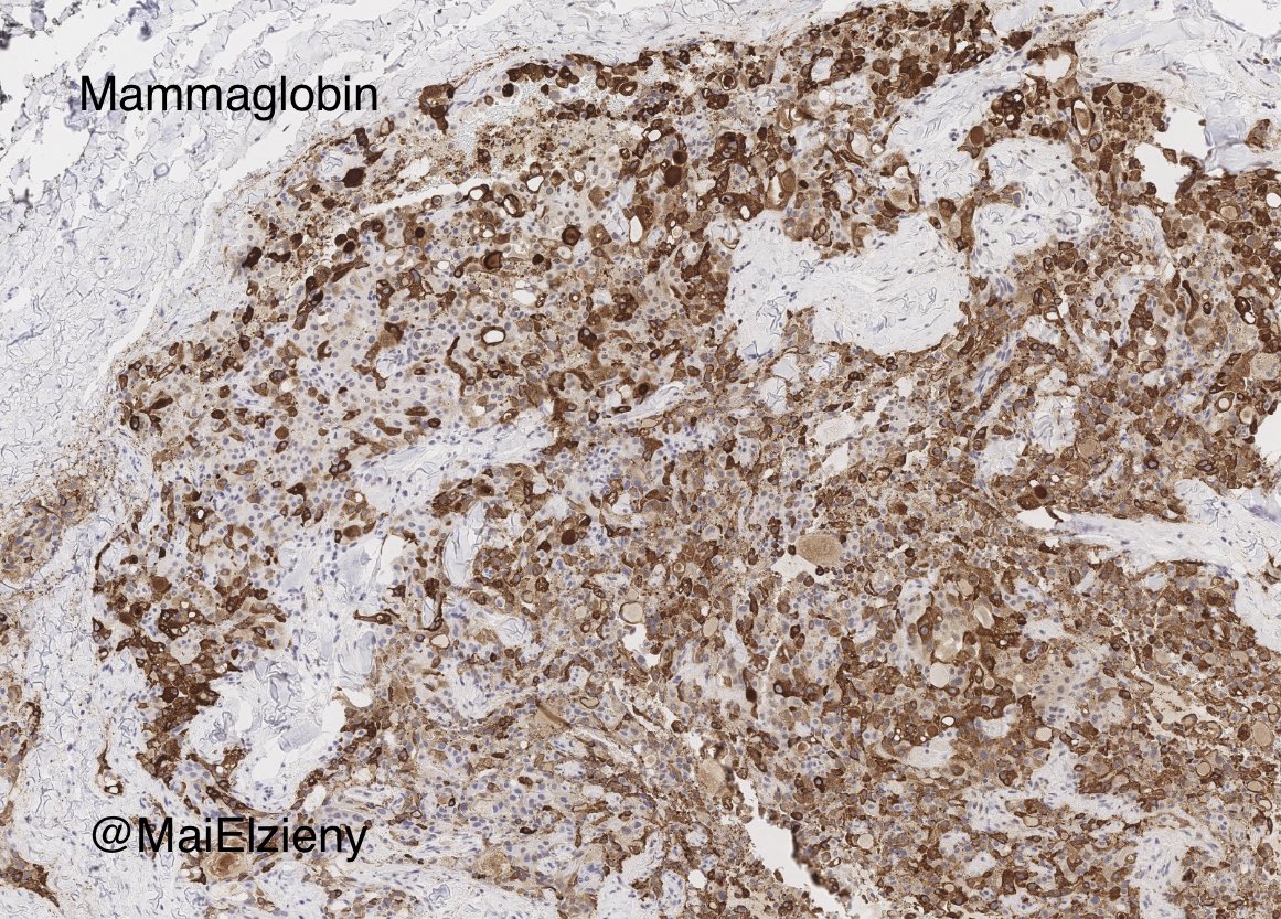 MaiElzieny's tweet image. Same parotid!
2 different locations!
2 different tumors!
#Pathology 
#PathX 
#PathTwitter