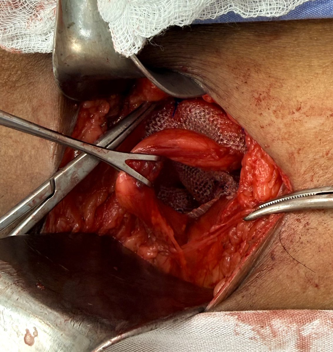 DrJAVazquez's tweet photo. Fin de semana de hernias. #LaParedImporta #SoMe4Surgery #SoME4IQLatAm #surgicalmentor https://t.co/tnfDg1jcKB