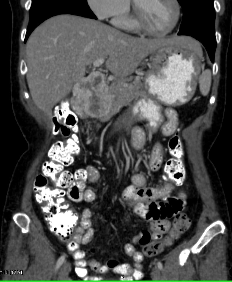 bwells80's tweet image. #RT @ctisus: Duodenal GIST Tumor