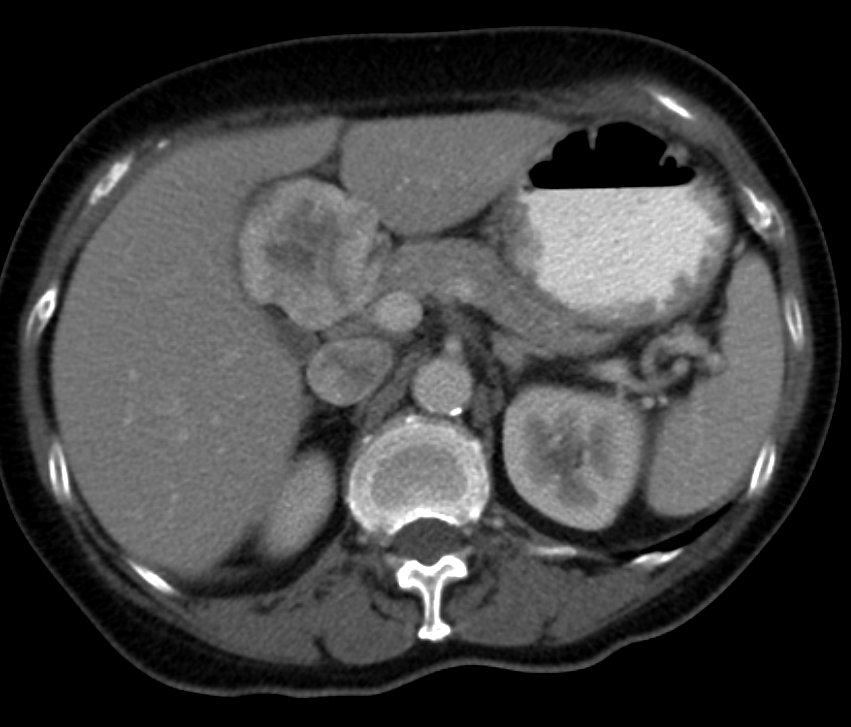 bwells80's tweet image. #RT @ctisus: Duodenal GIST Tumor