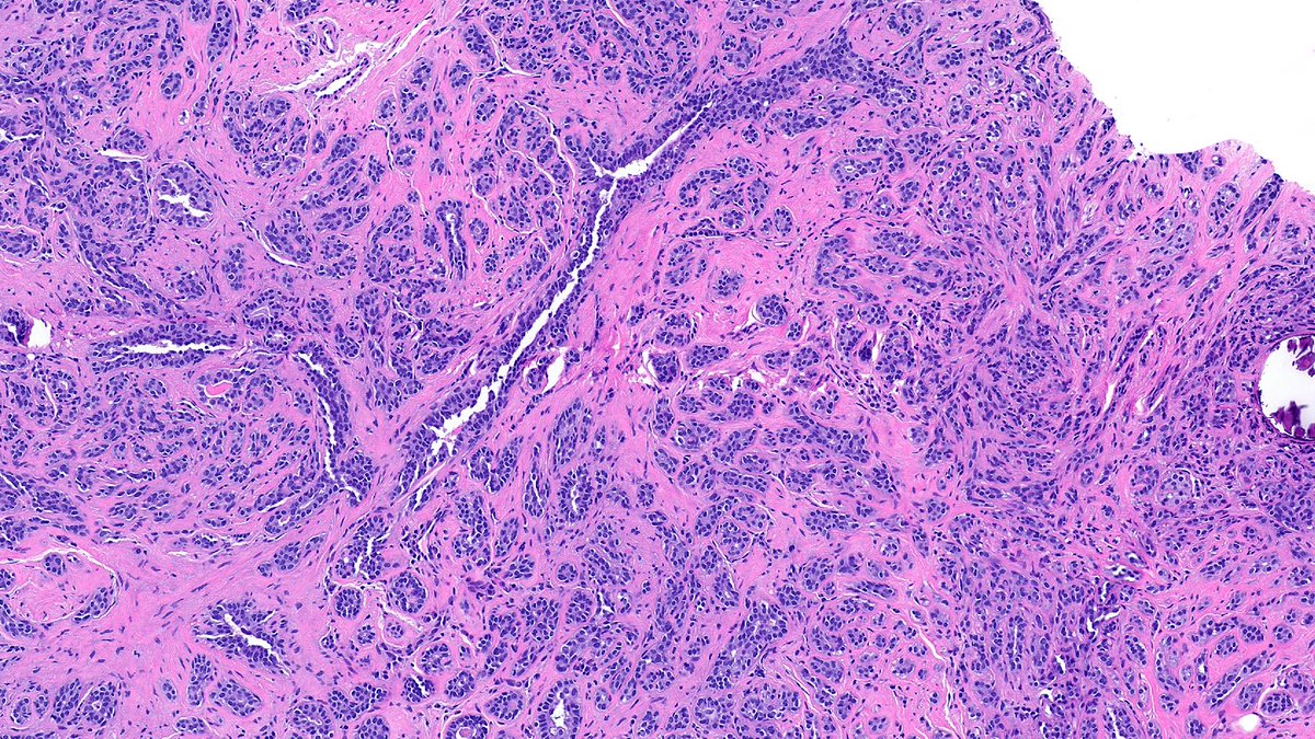 RazaHoda's tweet image. Let’s review sclerosing lesions of the breast this week! 🫚

Sclerosing Adenosis 🔬

A lobulocentric proliferation of compressed, distorted acini within a sclerotic stroma, which may mimic invasive carcinoma.

#PathX #PathTwitter #breastpath
