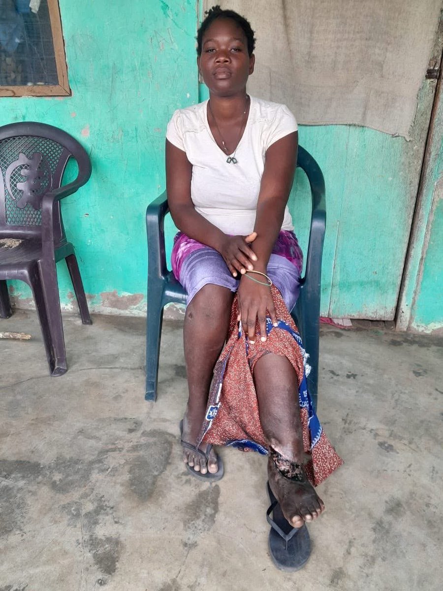 bonesmantv's tweet photo. Some months ago, I shared the story of 15-year-old Susan, whose leg was at risk of amputation without urgent surgical intervention. 
Fortunately, Hon. Sam George @samgeorgegh , Minister for Communication and Innovation, and the @dzatafoundation stepped forward to cover the costs, and the procedure was successfully undertaken. 
During a recent visit to Susan, I was overjoyed to see her walking independently, a testament to the positive outcome of their support. 
For years, Susan had struggled with mobility issues, but now she can walk freely without assistance. 
My heartfelt thanks go to Hon. Sam George and Madam Vera George for their generosity and to everyone who contributed towards this remarkable turnaround. May God bless all who supported this cause