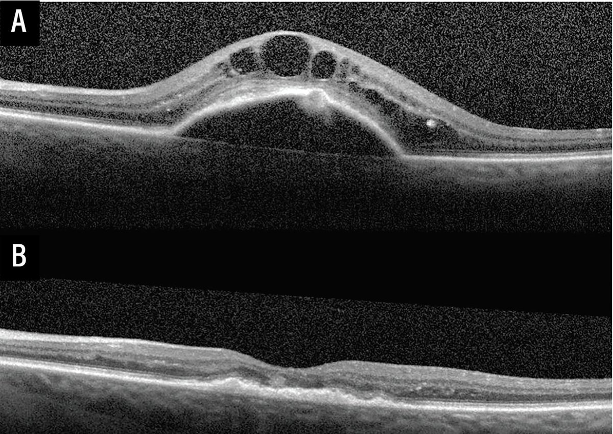 RetSpecMag's tweet image. Why I treat wet AMD patients until dry

Treating patients until dry optimizes long-term vision.

Hear from Nikolas J.S. London, MD, FACS, and Thomas Lazzarini, MD: retina-specialist.com/article/why-i-…

#retina #retinaspecialist #ophthalmology #ophthalmologist #eyecare #maculardegeneration