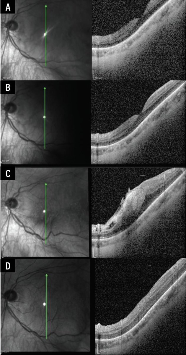 RetSpecMag's tweet photo. Managing hyperacute epiretinal membranes

Expert guidance on selecting interventions for optimal visual outcomes.
https://t.co/MYjx6xtTlu

#retina #retinaspecialist #ophthalmology #ophthalmologist #eyecare #epiretinalmembrane https://t.co/P1zeYjlUOY