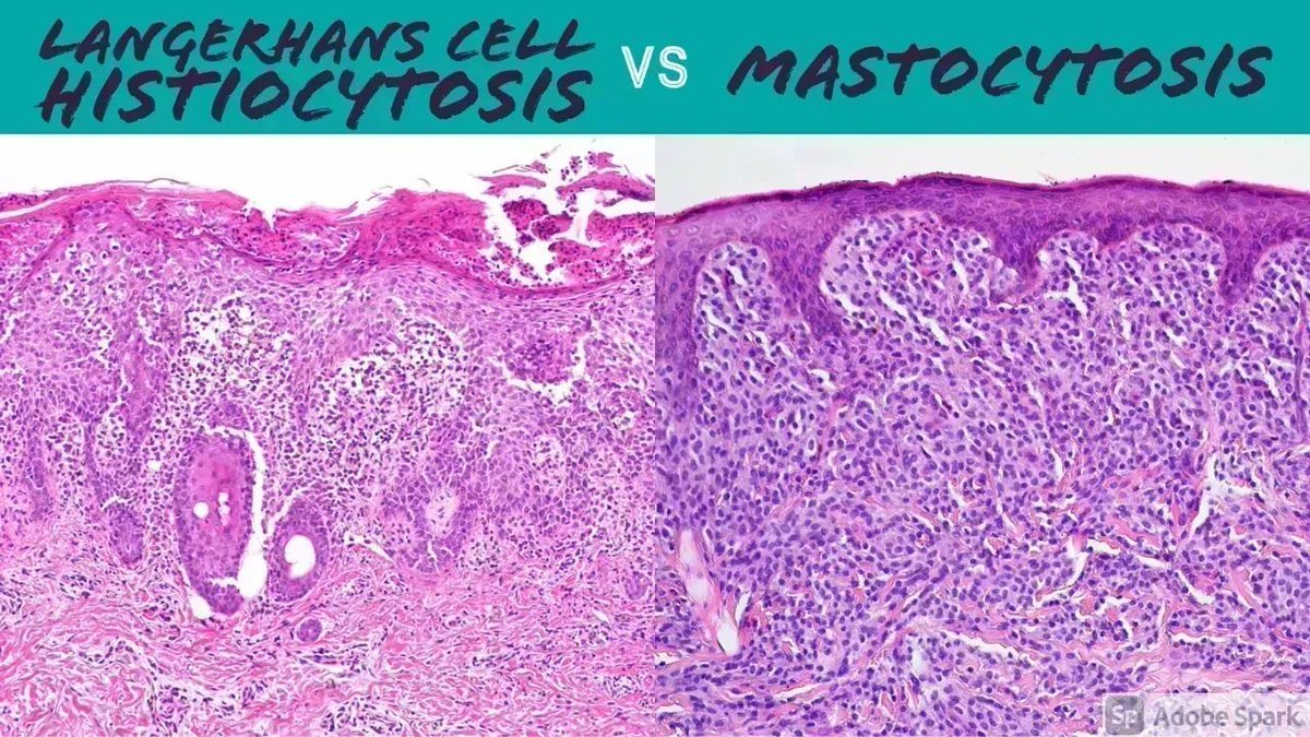 JMGardnerMD's tweet image. How to distinguish Langerhans Cell Histiocytosis (LCH) vs Mastocytosis on H&amp;amp;E only. 
Short Video: youtube.com/watch?v=zfuDpa… 
Classic pics of LCH: kikoxp.com/posts/22380
#pathology #pathologists #pathTwitter #dermpath #dermatology #dermatologia #dermtwitter #pedipath