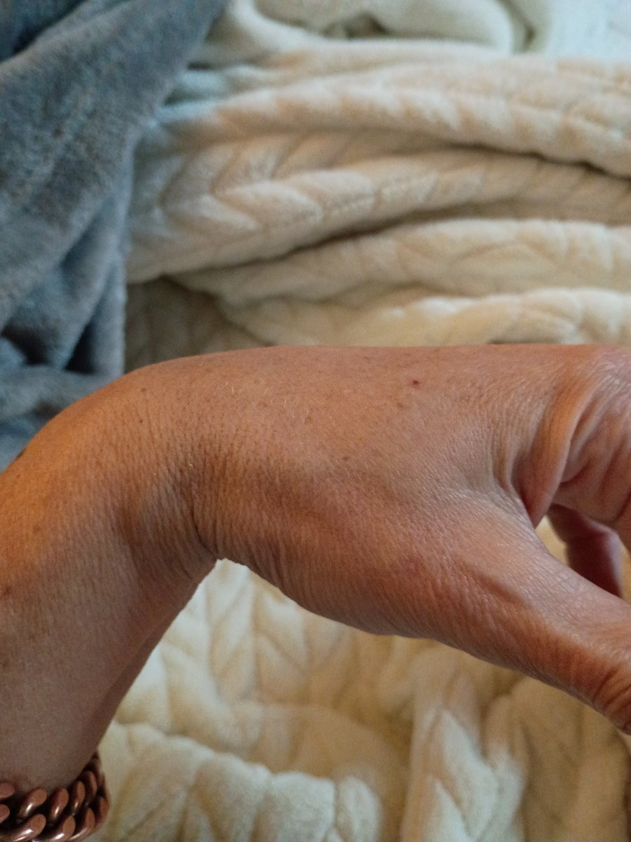 SarahReally8899's tweet photo. Here's mine. Inserted on my right hand during a mole removal(sensor node). The doctor that did the procedure also delivered my son. And 2 odd lumps appeared underneath my skin after the procedure.
(Left hand picture for a comparison)
#Verichip #SensorNodes https://t.co/qHPgPDE9sC