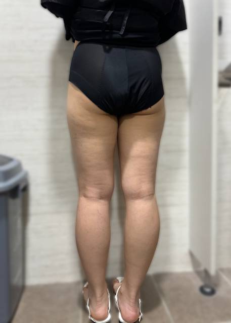 LE_ROSE_JP's tweet photo. 下半身の脂肪吸引でもう一つ大事なポイントは「膝」です！🥰

膝にも意外と脂肪がついている方は多いんです。

膝まわりをしっかりスリムに整えることで、細くなった太ももとのラインがよりきれいにつながります。

ぜひお気軽にご相談ください！😘

#脂肪吸引 #脂肪移植 #韓国 https://t.co/W9Yriy4ZV5