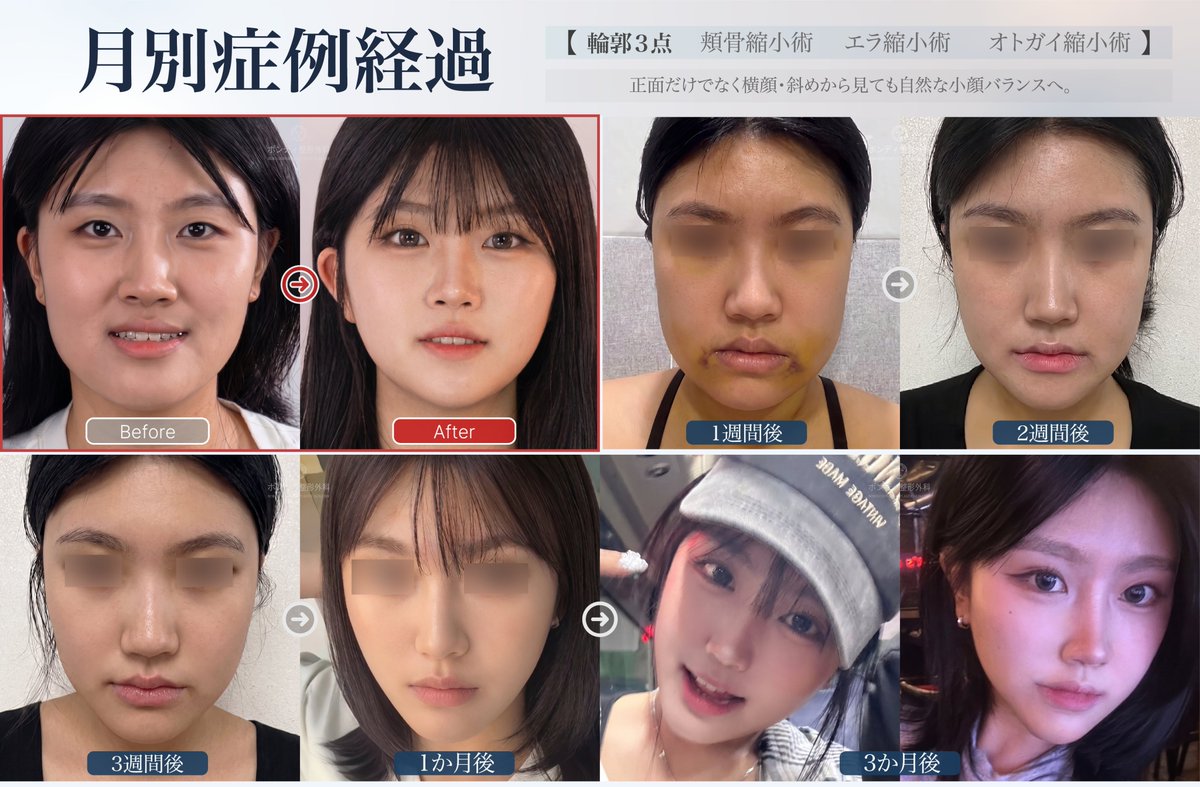 韓国ボンディ美容整形外科 BORN:DI PLASTIC SURGERY tweet media