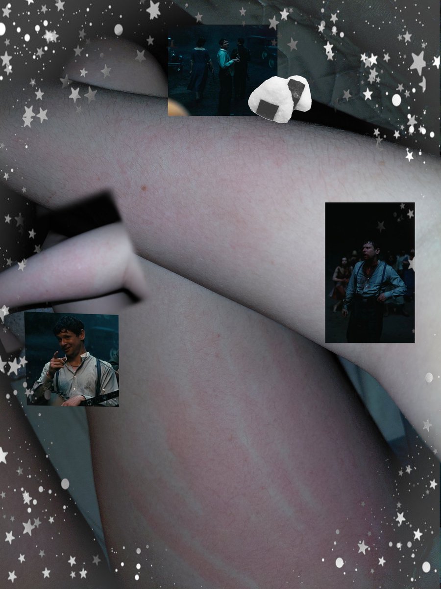 H1lsonsupremacy's tweet image. You can barely see it, but whatever
Take my shitty editing ok
Bites + scratching
#shtwt #scratching #biting #shedtwt #bruisetwt
