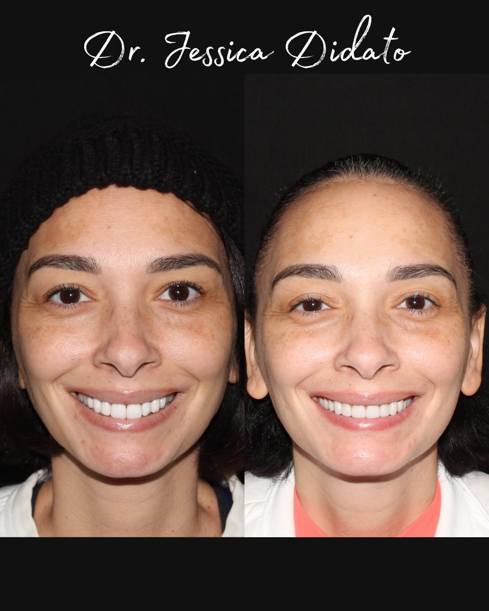 Say goodbye to bulky, artificial white and hello to a soft, natural smile. ✨

Latest smile revision work in collaboration with @bobbyianto. It’s all about the details that make a smile look real. 🦷

#SmileMakeover #CosmeticDentistry #SmileRevision #DentalArt
