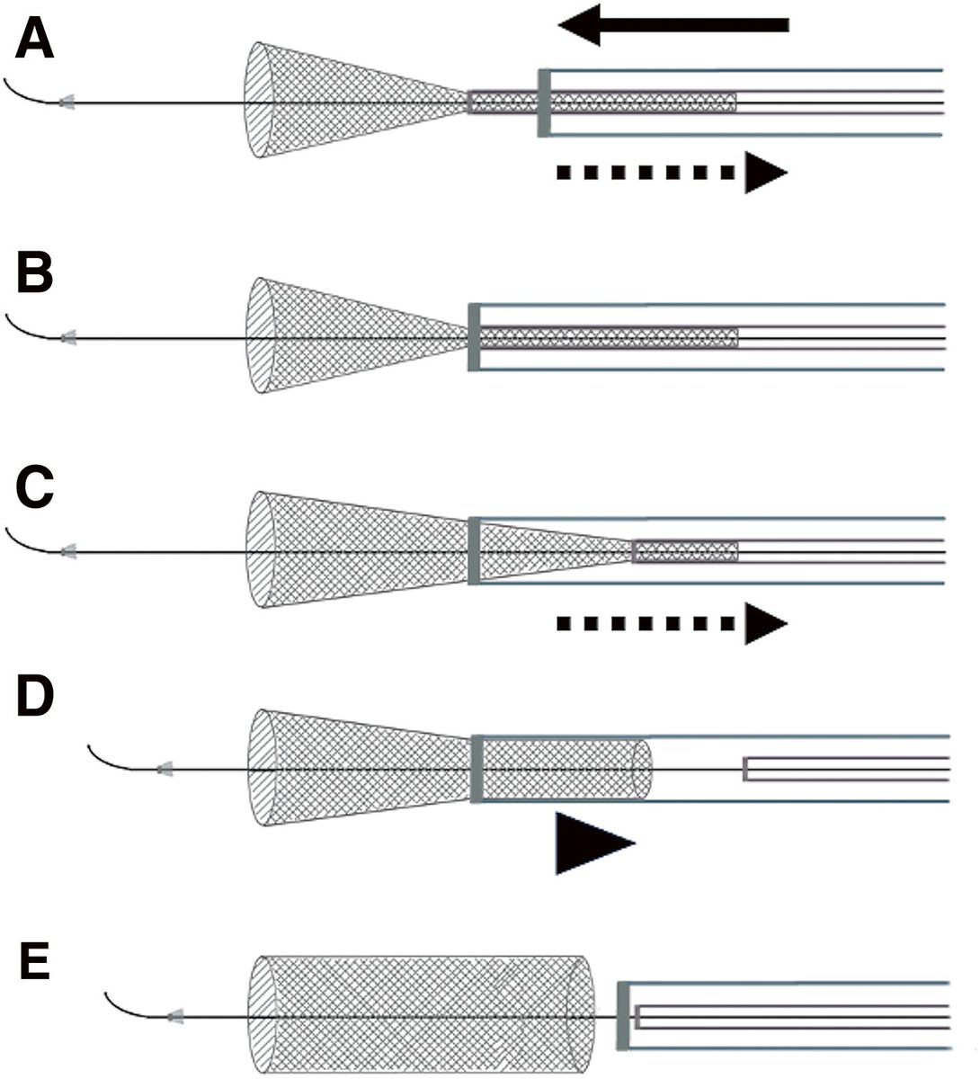 JNET(Journal of Neuroendovascular Therapy) tweet media