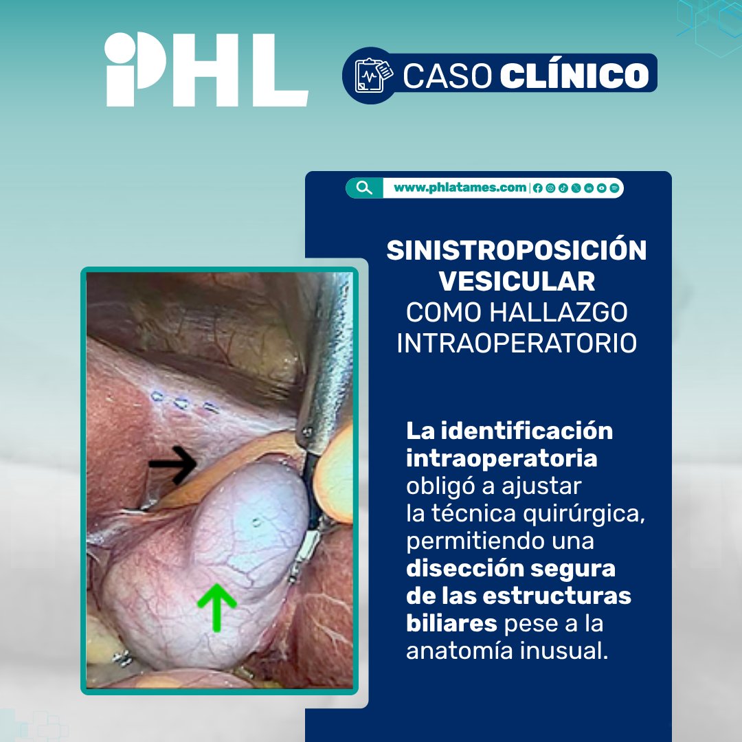 PH_Latam's tweet image. 🔬 ¡Caso Clínico! | Le contamos 📲 ow.ly/V1Cv50YK8LO 
Una vesícula en el lado izquierdo puede cambiar todo en quirófano.

Durante una colecistectomía laparoscópica por colelitiasis, se identificó una vesícula biliar ubicada en el lado izquierdo del hígado.

#PHL #Cirugía