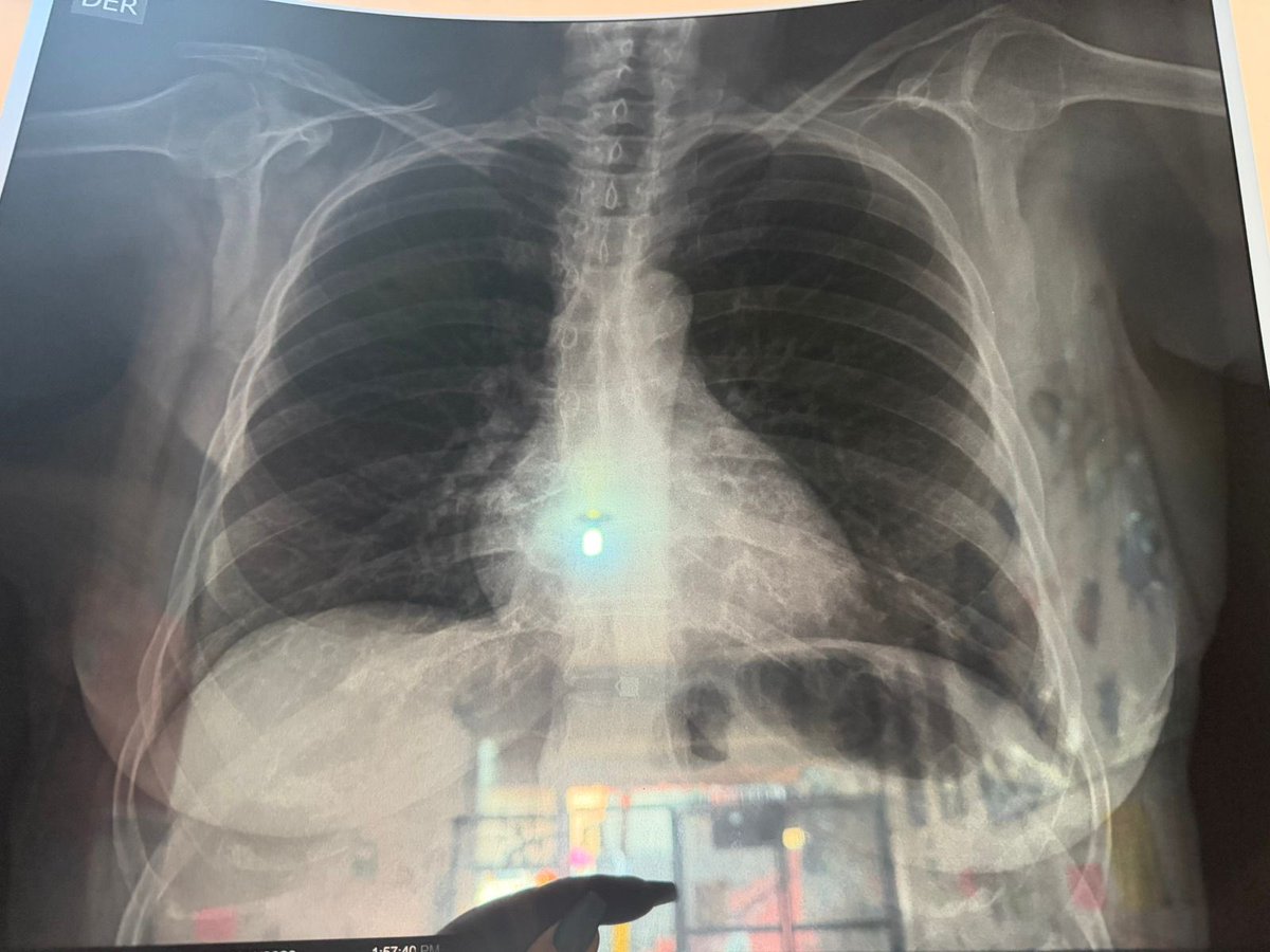 med_amargado's tweet photo. Una tía se cayó en octubre y sufrió una fractura de Colles, le pidieron una Rx de tórax para valoración preoperatoria. Le dieron cita para tomar la Rx el día 14/04/26, o sea para ayer. Un trauma la operó sin valoración preqx y todo bien.
Y bueno, ayer fue a tomarse la Rx de tórax https://t.co/d4q77giA2O