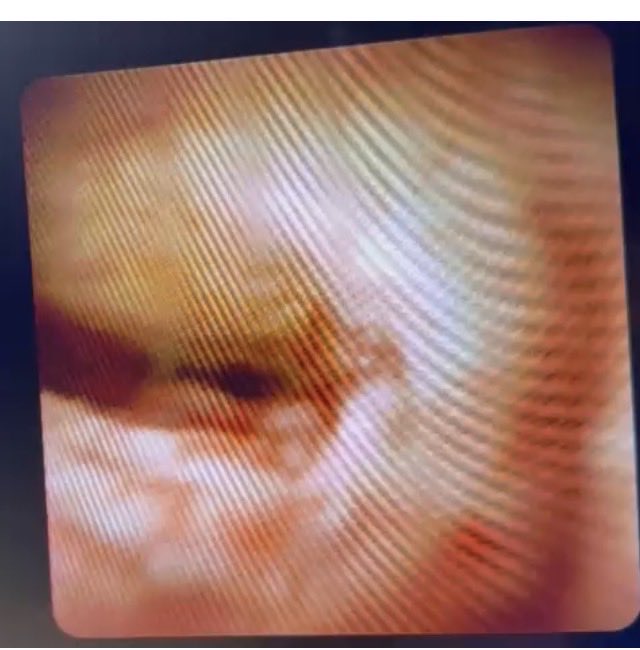 Almotasembilla1's tweet photo. 3 cholangioscopy/Spyglass in one day for CBD stone/Mirizzi/CBD strictures,Endoscopy team,National Guard Hospital,Jeddah @SurgMBA @NGHAnews @Taalamri @mawardim1 @AllehibiAbed @ealjahdli @Alharbi_A_W @ibrahimjelaidan @MajedMM10 @DrAhmedAlShehri @MSAlkhattabi @Ralkhiari @majidalsahafi @AzzamKhankan @ibrahimjelaidan @dr_Resini @Dr_Almoaid @AgeelAmro @DrMajedAbdulhaq @kayal_ahmed @DrAmmarAlotaibi
@iDrAmmar @AlrahimiJ @AlmuhaidbAymen @DrAlsohaibani
