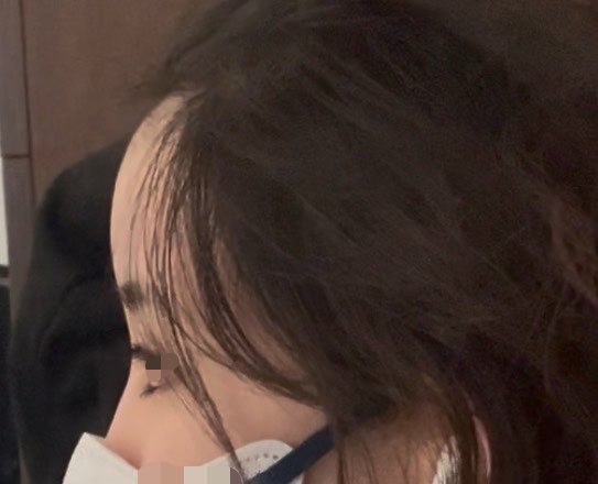 下顔面コンプ グラマラス切開+涙袋形成dt中、5.20自家真皮貴族予定、24.08.21~歯列矯正 tweet media