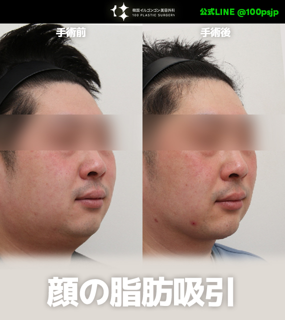 韓国イルゴンゴン美容外科 tweet media