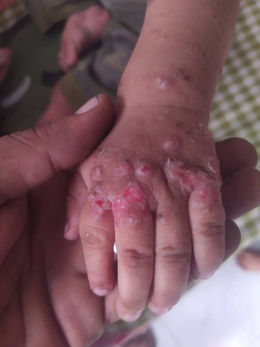 Scabies has spread all over my child's body I am worried about my baby girl ☹️😭

gofund.me/62fb9062d