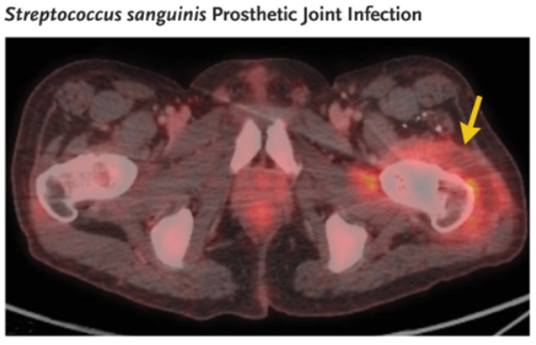 guerreroespejo's tweet image. Fever of Unknown Origin of 6 months in a patient who had Crohn’s disease: fevers, sweats, &amp;amp; weight loss

FDG PET-CT scan: a fluid collection in the hip prosthesis (arrow), with cultures yielding Streptococcus sanguinis.

#MedEd #medicine
DOI: 10.1056/NEJMra2111003