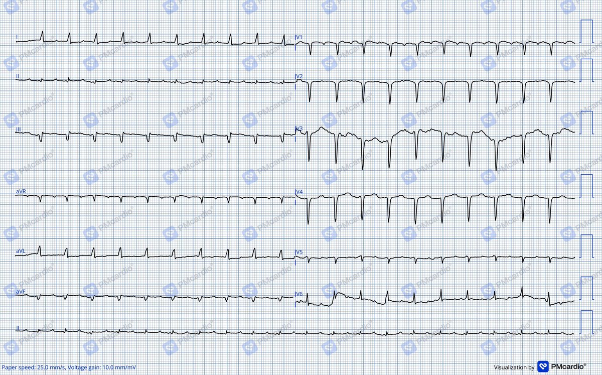 thesuperdocs's tweet photo. Systemic interpretation 
@DrNikhilMD @ecgchallenge @ecgandrhythmRoe @ecgrhythms https://t.co/1d3SClxGnd