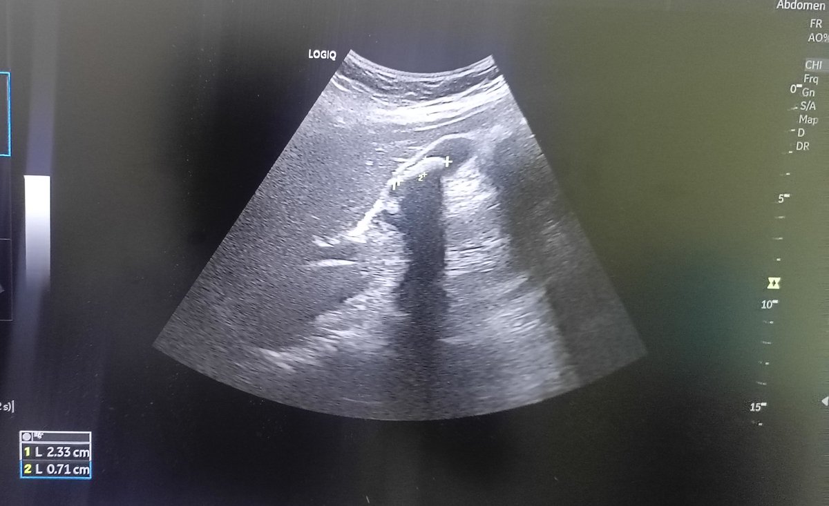 RoentgenPikin's tweet image. Cholelithiasis (GB Stone) and 
Renal parenchyma Dx. 
#medicalimaging #USS #Medicalultrasound #GB #Cholelithiasis  
#kidney #calculi