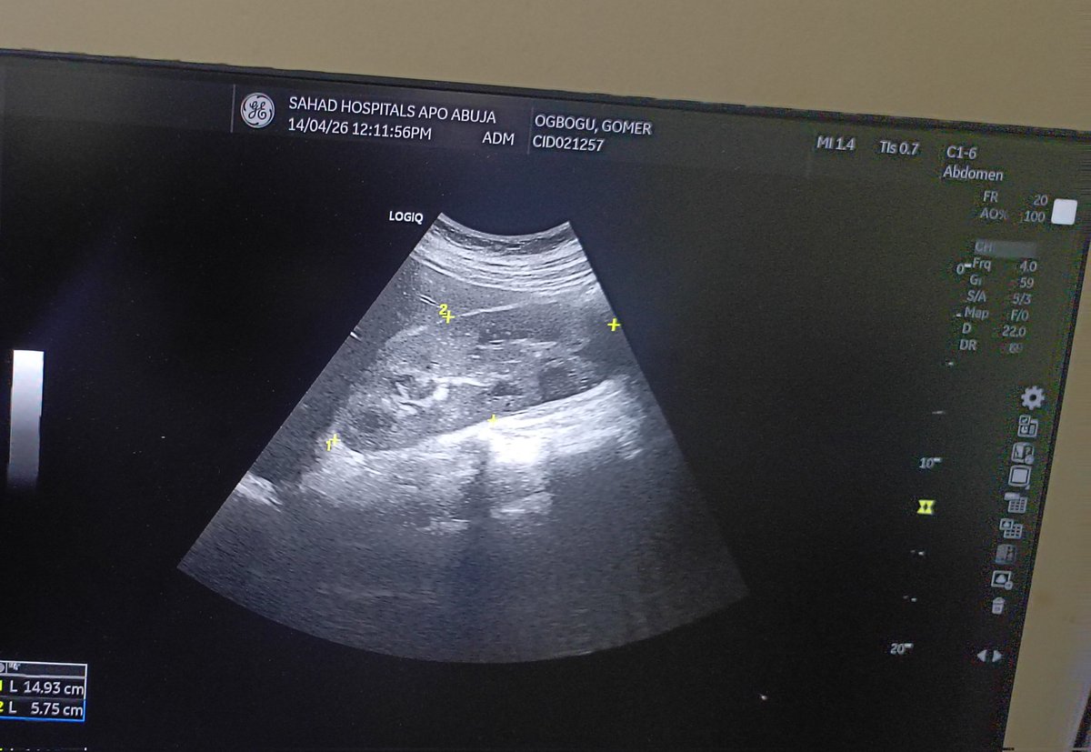 RoentgenPikin's tweet image. Cholelithiasis (GB Stone) and 
Renal parenchyma Dx. 
#medicalimaging #USS #Medicalultrasound #GB #Cholelithiasis  
#kidney #calculi