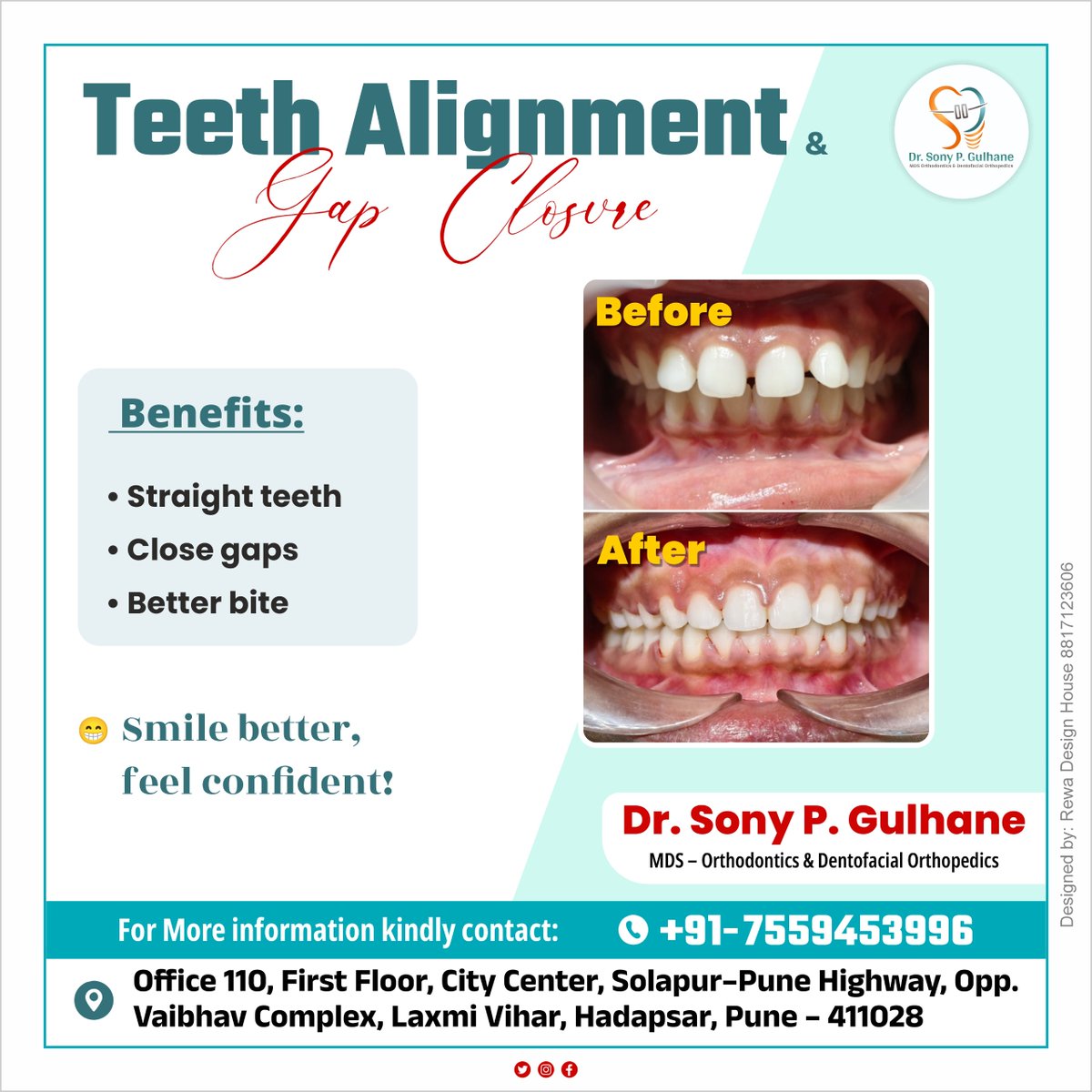 drsonygulhane's tweet image. 😁✨ Straighten your smile &amp;amp; boost your confidence!

Say goodbye to gaps and hello to a perfectly aligned smile with expert orthodontic care. 🦷💫

#TeethAlignment #GapClosure #Orthodontics #HealthySmile #PuneDentist #SmileMakeover #DentalCare #ConfidenceBoost #Braces #Invisalign