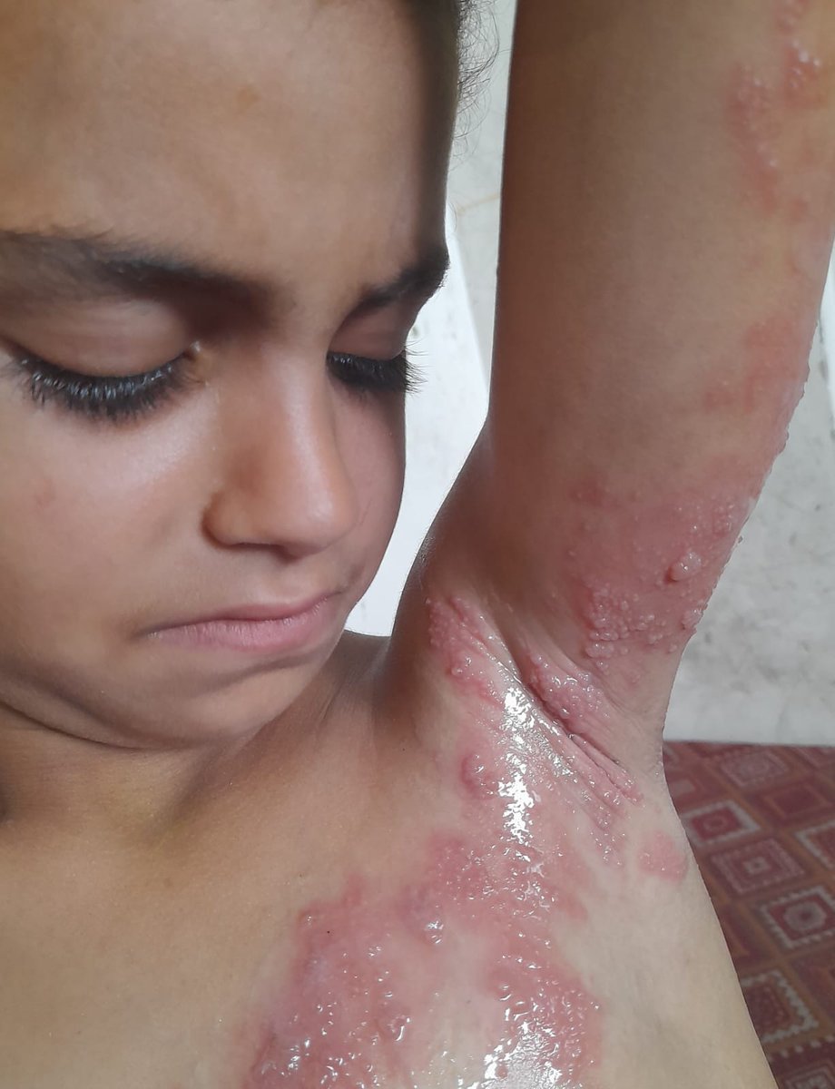 My little girl is burning with pain all over her body. Don't leave me and my child crying bitterly Pray for her 

chuffed.org/project/138194…