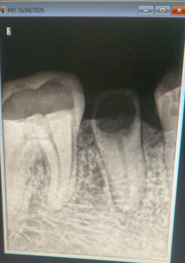 VitalTooth_'s tweet image. This 42/M wanted to save this grossly decayed tooth !! 

I mean, there will be some expectations . But , I am not a magician!! 

For #dental #oralhealth queries visit 👇🏻

vitaltooth.in