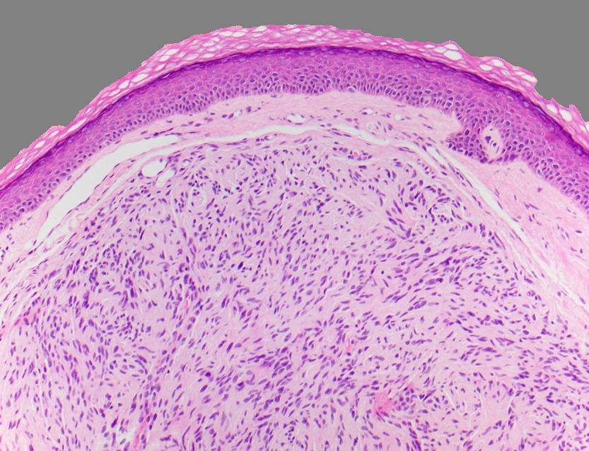 DrCycloPath's tweet image. #PathQuiz 🔬🧬

A) Neurofibroma
B) Schwannoma
C) Angioleiomyoma
D) Solitary Circumscribed Neuroma

#Pathology #DermPath #SurgPath