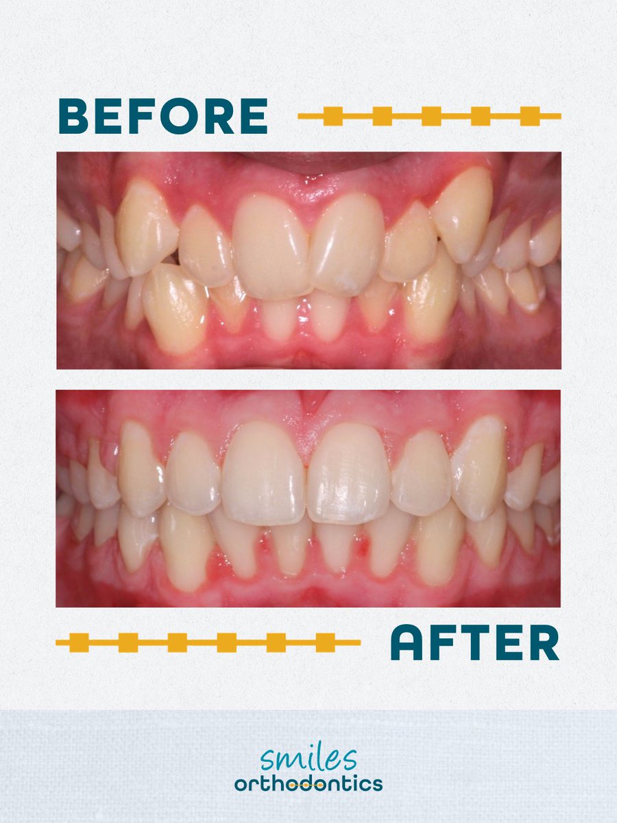 smilesortho's tweet image. What an amazing transformation for our friend, Austin! 🙌🎉
Keep smiling, buddy. Your grin is one of a kind! 😄

#SmileTransformation #TransformationThursday #NewSmile #Orthodontics #WichitaKS