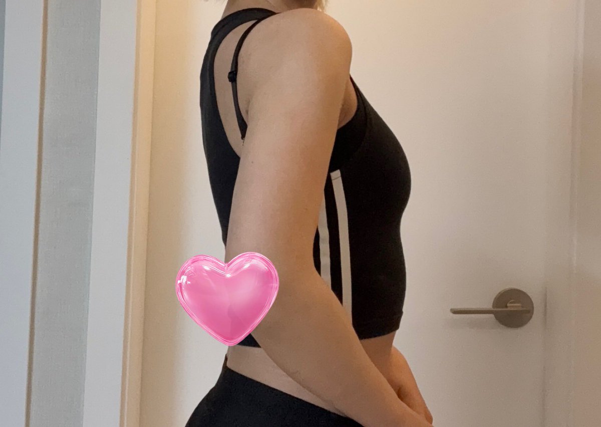 the_a_you's tweet photo. 二の腕+腹部吸引と胸移植1次から2ヶ月が経ちダウンタイムの1/3が過ぎました！痛みはほぼなくなり拘縮もかなり治りました😌腕はまだ完全には上がらないですが、日常生活に大きな支障は来していないかなと思います。明日太ももの吸引と胸移植の2次があるのでこちらも楽しみです👌🏻
#レアート #ソ院長 https://t.co/vl3ZV2DOTC
