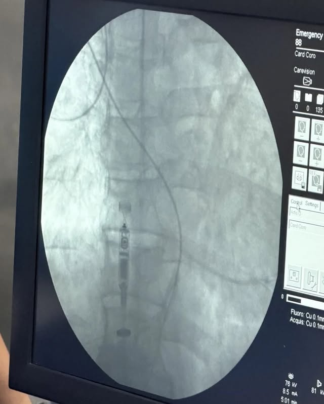 webnotitarde's tweet photo. #Salud | 🫀🏥 ¡Histórico! Implantan en el estado Monagas el marcapasos más pequeño del mundo

Por primera vez en Monagas, se realizó la implementación de un marcapasos tipo "Micra", sin cable, un procedimiento clínico que resultó de manera exitosa.

📸: RRSS https://t.co/r9L1kUVguW