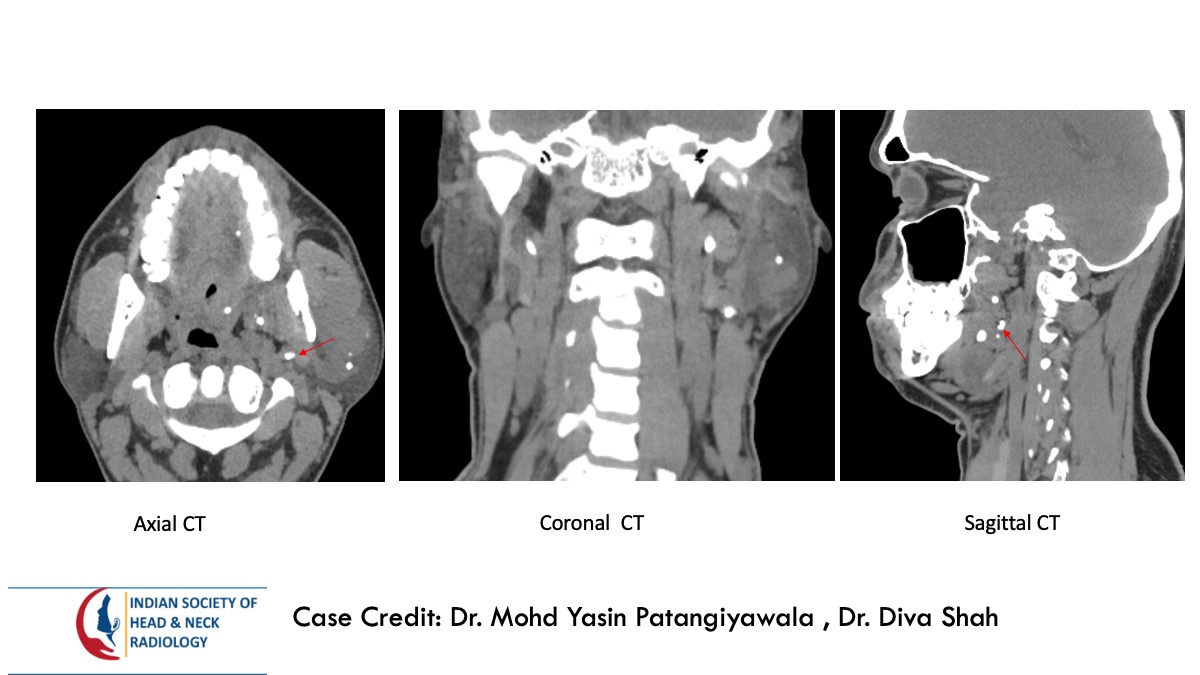 teamishnr's tweet photo. #caseoftheweekanswer

Please find the answer
#radiology #caseoftheweek #headandneck #radiologycases #dailywork #ISHNR #teaching #research #imaging #FOAM #FOAMRad #FOAMMed

Visit our website: https://t.co/WeZDMv0UAa
All Cases: https://t.co/0xaPvoBy5H https://t.co/fjAexK4azW