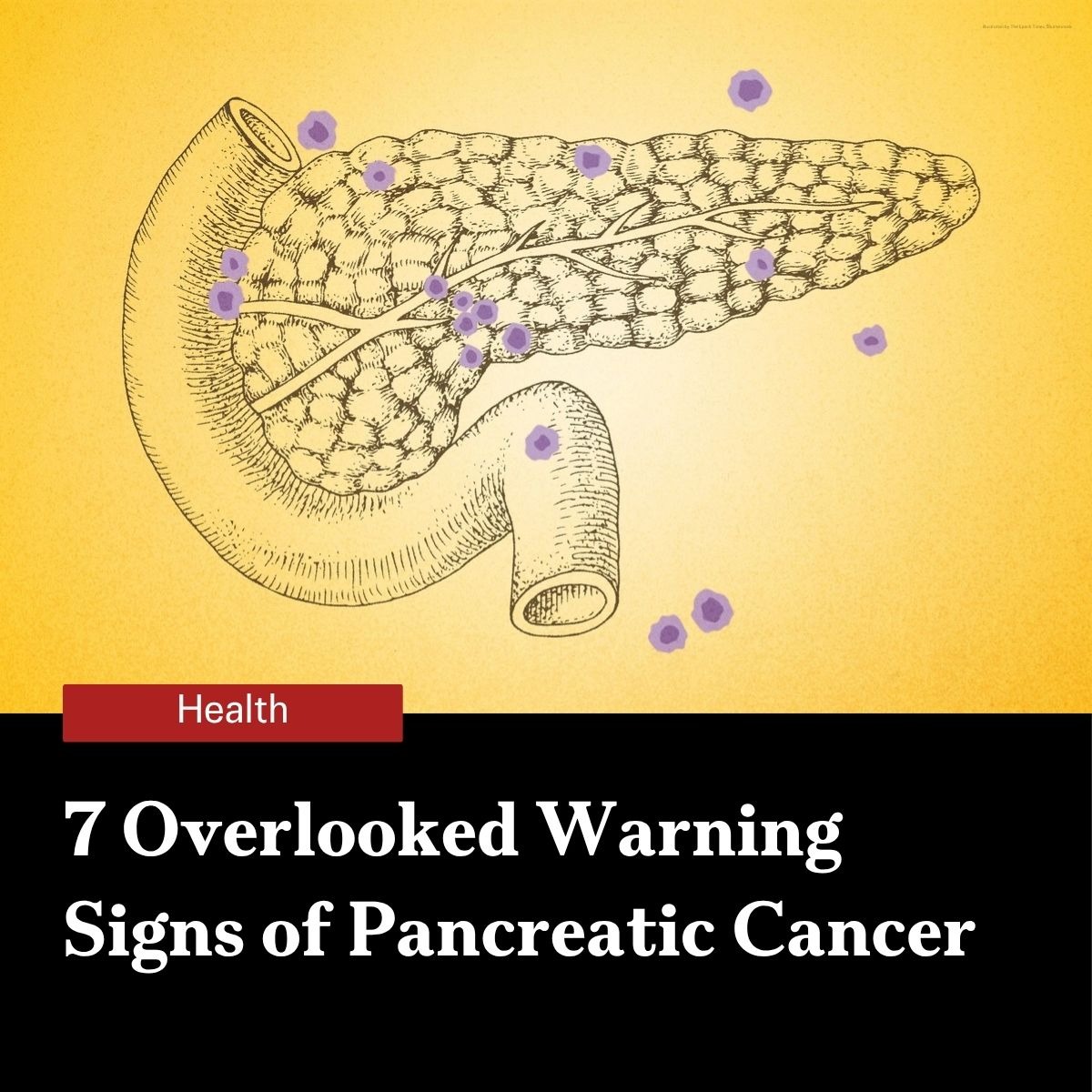 epochhealth's tweet photo. 🚨Pancreatic cancer rarely announces itself. When it is caught at the earliest stage, 5-year survival tops 80 percent. Once it spreads distantly, that drops to 3 percent. 

Three specialists walk through the 7 signs that most often get dismissed as something else.