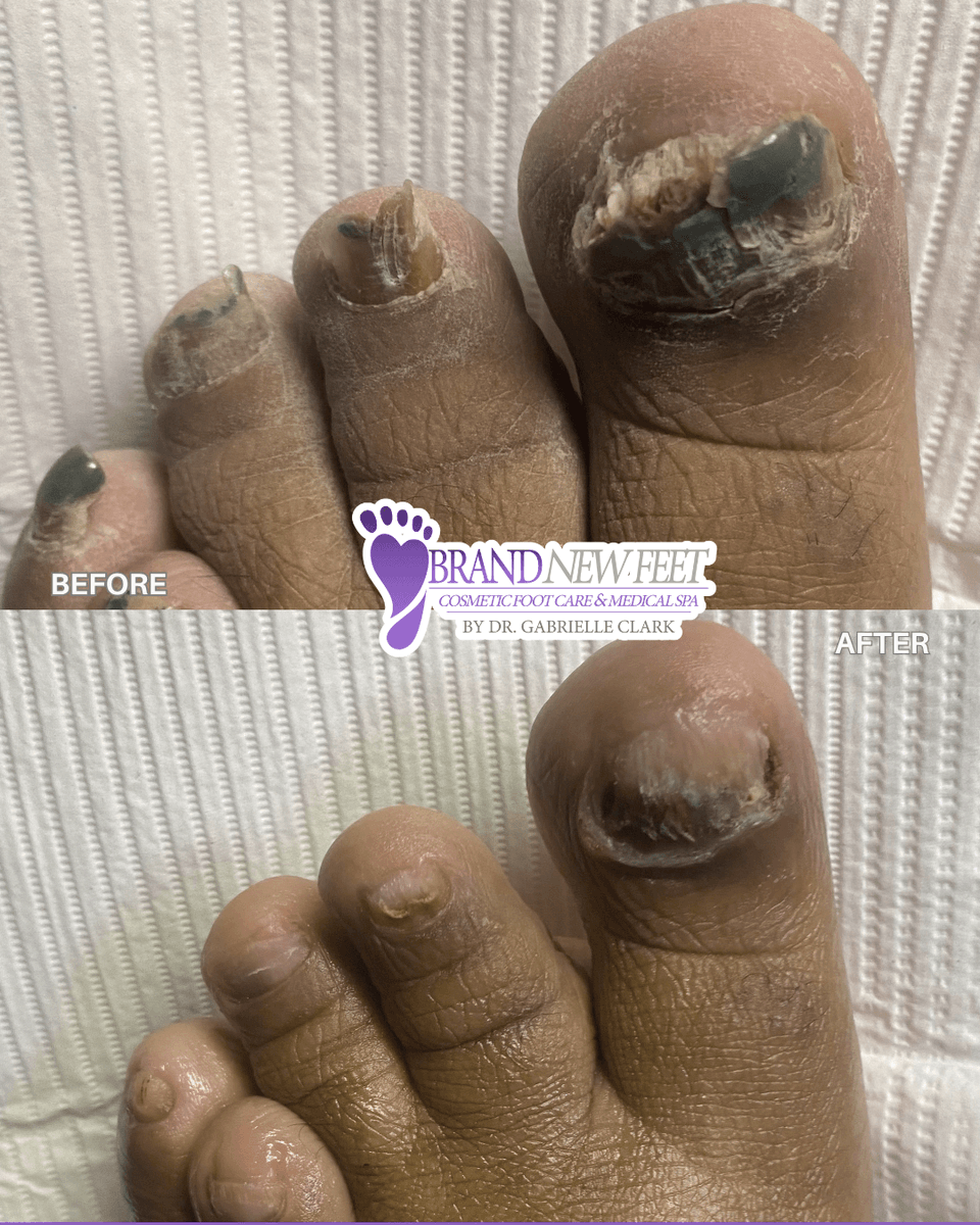 mybrandnewfeet's tweet image. Your feet carry you every single day. When did you last take care of them? 🦶💜

 Our doctor led Medical Pedicure at Brand New Feet restores foot health and confidence.
 Book today! 📞 (504) 475-FEET (3338) | brandnewfeet.com 

#BrandNewFeet #FootHealth