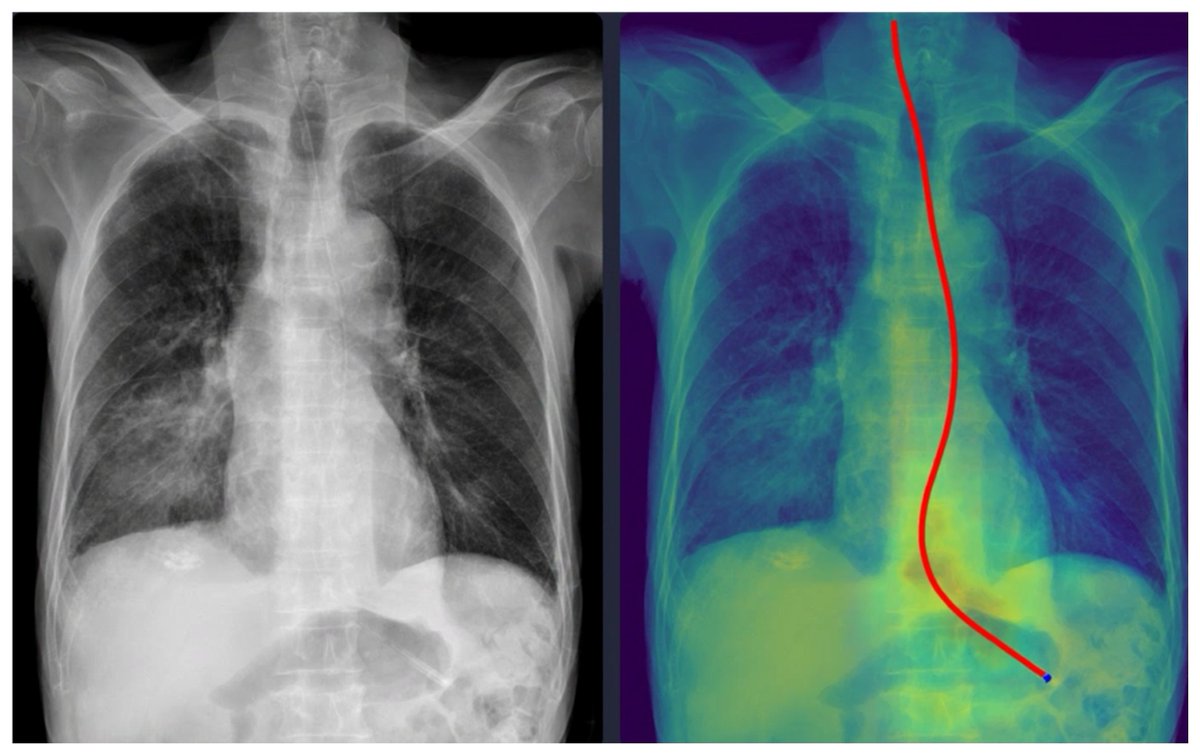 Tomography_MDPI's tweet image. 🤖 In our recent article published in #Tomography, we explore how a deep learning model can assist in assessing nasogastric tube positioning on chest radiographs, aiming to enhance reliability and support clinical decision making.

🔗 brnw.ch/21x1EQM

#DeepLearning #AI