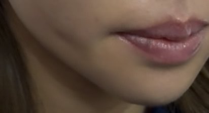 rickkk529's tweet photo. 糸リフト、一週間経ってもこの凹み消えない
固いし、なんか塊がある
どうなってるのこれ😭
韓国でやったから修正してくれるところ日本で見つけないと😭😭 https://t.co/kKyBG6cPYW