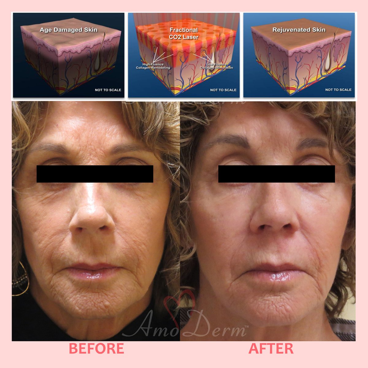 Amoderm's tweet photo. Fractional CO2 Laser Limited-time Offer - https://t.co/ezthxMTtz3 https://t.co/p12knRSP7R