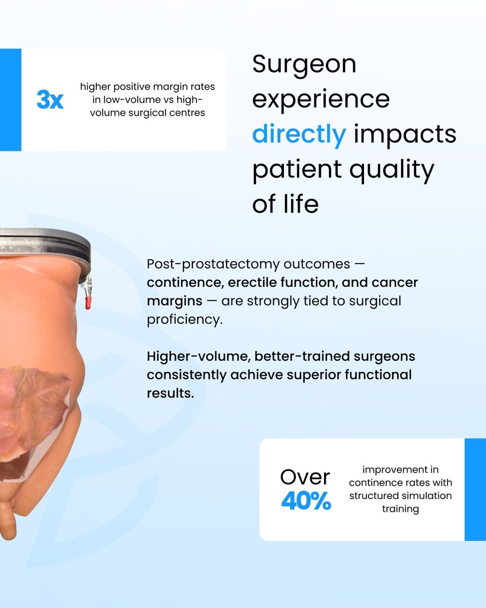 IMRASurgical's tweet photo. Robotic prostatectomy is now the standard of care for prostate cancer — but the learning curve is steep.

Research suggests surgeons need 150–250+ procedures to reach proficiency. And the steps that matter most — nerve-sparing dissection, urethral anastomosis — are the ones where experience has the greatest impact on patient quality of life.

The challenge for training programs isn't access to the robot. It's creating enough quality repetitions before surgeons are unsupervised.

That's what realistic simulation is for.

Swipe through to see why surgical training in robotic prostatectomy matters — and what good preparation actually looks like. 

#UrologySurgery #RoboticSurgery #SurgicalTraining #Prostatectomy #MedicalEducation #Urology