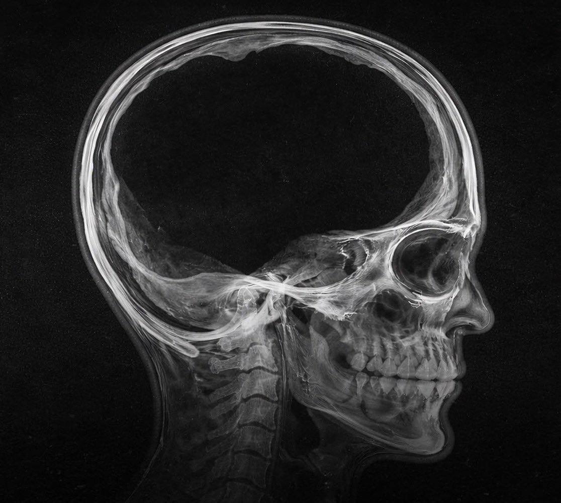 0xFrenxbtdotxrp's tweet photo. A man was discovered with almost 90% of his brain mass missing, while leading an almost normal life as a Chill House holder. https://t.co/v8OGscglGz